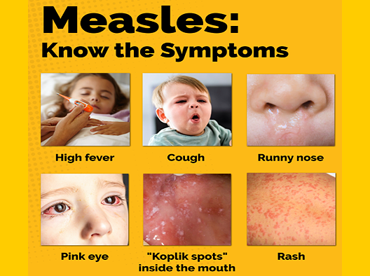 Measles Symptoms Chart